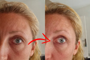 Cernes sous les yeux avant et après la réflexologie faciale