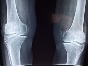 Radiographie des 2 genoux