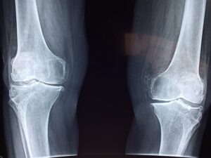 Radiographie de 2 genoux